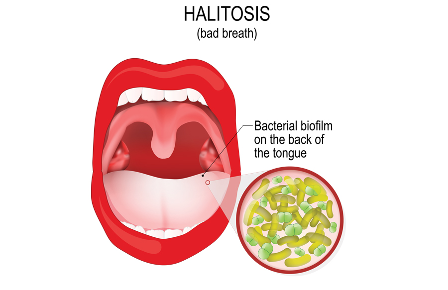 halitosis-biofilm